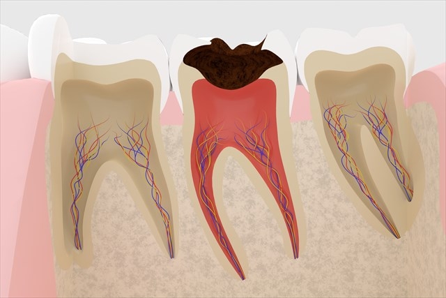 虫歯の根管イメージ