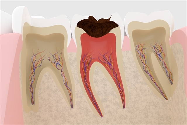 虫歯の進行速度はどのくらい？段階別の症状と治療法も解説