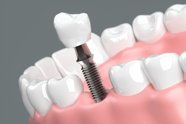 差し歯とインプラントの違いとは？治療方法・流れ・費用の目安も紹介