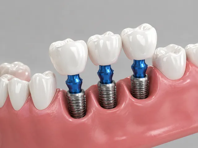 インプラントのイメージ